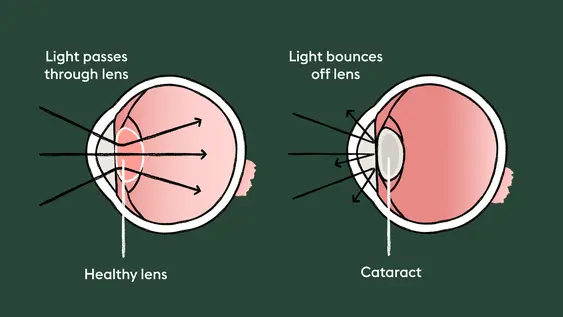 The graphic shows the difference between a healthy eye and an eye with a cataract.
