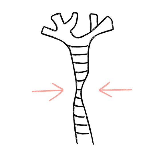 A line drawing diagram of a trachea with pink arrows indicating the direction of collapse